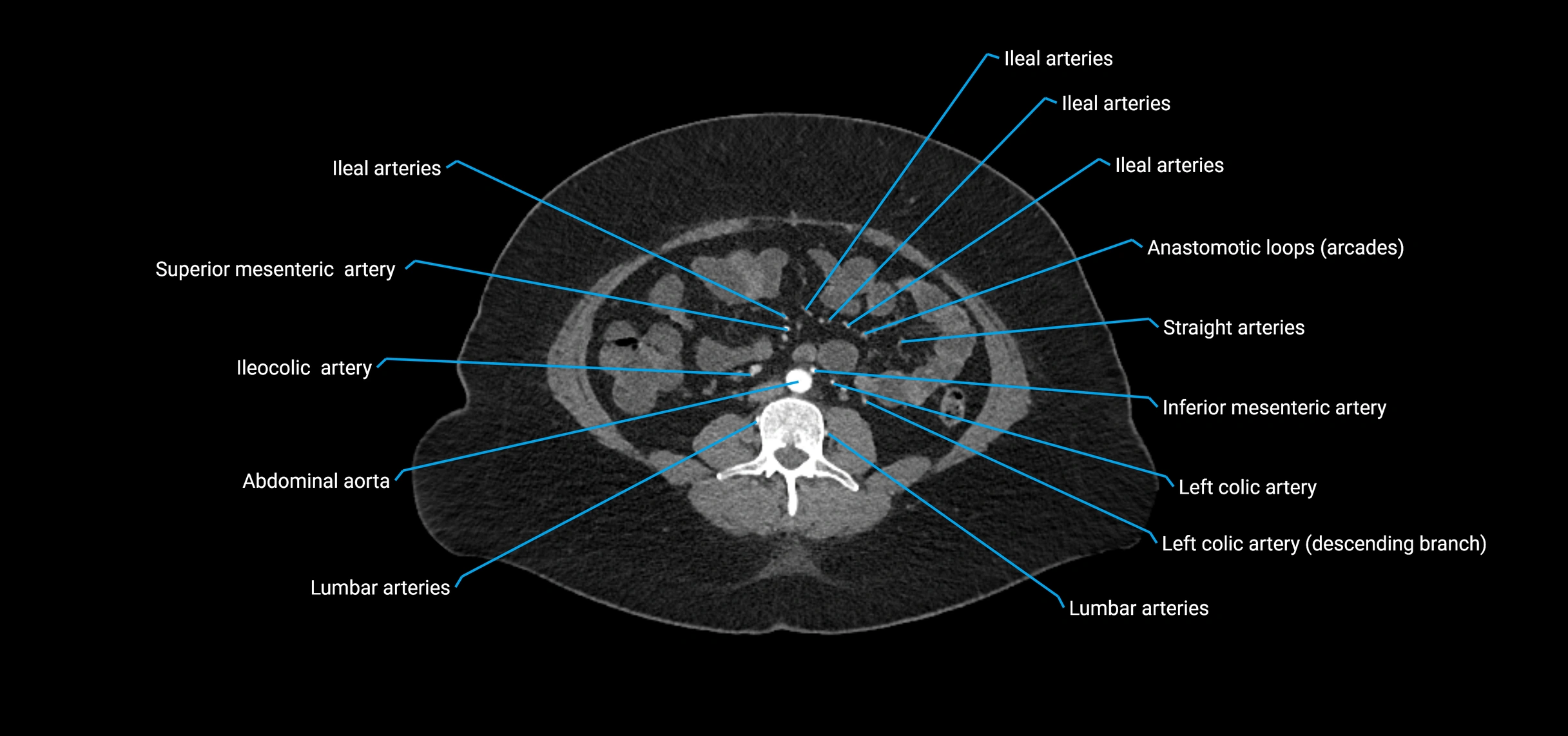 CTA abdomen axial cross sectional anatomy labelled image_117 (2).webp